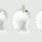 Neuralink, el implante cerebral en seres humanos podría estar listo para 2023