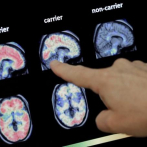 Un hallazgo molecular explicaría por qué el alzhéimer afecta más a mujeres