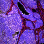 Un estudio descubre un nuevo bloqueador molecular que frena la metástasis del cáncer de mama