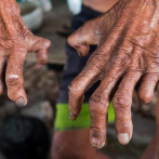 La lepra está casi extinguida en el país