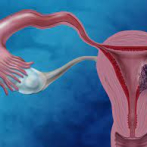 Revelan el papel clave de una proteína en el cáncer de endometrio