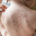 El país registra 3,693 casos de varicela en lo que va de año