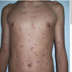 Especialistas sugieren aislamiento, higiene y vacuna contra la varicela