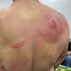 Bad Bunny muestra su espalda con arañazos y hematomas tras pelea en WWE