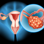 Día Mundial del Cáncer de Ovario: Un tumor sigiloso que afecta a más mujeres