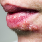 Malas prácticas estéticas pueden provocar herpes y hepatitis C