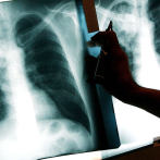 Tuberculosis está bajo control pese a daños del Covid