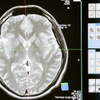 Un ensayo clínico logra reducir el tamaño de un raro tumor cerebral en un 91 %