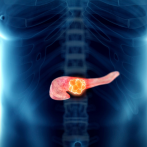 Una vacuna muestra potencial frente a las recaídas de cáncer de pancreas y colon
