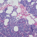 Mieloma múltiple, un cáncer de sangre poco visto
