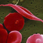 La FDA aprueba 2 terapias genéticas para la anemia falciforme