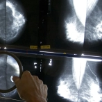 Es posible que sobrevivientes de cáncer de mama no necesiten tantas mamografías después de cirugía