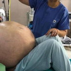 Extirpan tumor de más de 50 kilos del abdomen de una mujer en Italia