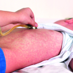 Especialistas sugieren robustecer la vigilancia contra sarampión, rubeola y polio