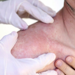 Incart y Dermatológico unirán esfuerzos contra el cáncer de piel
