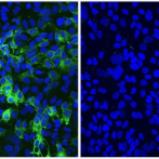 Identifican marcadores para diagnóstico de patologías hepáticas graves tras curación de hepatitis C