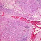 La OMS precalifica la primera prueba diagnóstica de tuberculosis