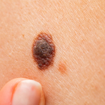 ¡Cuidado con los rayos ultravioleta! Son la principal causa del melanoma cutáneo