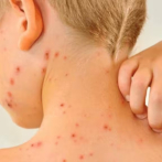 Los casos de sarampión superan los 4,500