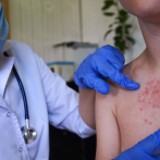 Sociedad Infectología alerta a RD sobre riesgo de sarampión