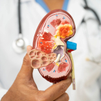 Diseñan una terapia celular con potencial para controlar el rechazo en trasplantes de riñón