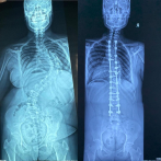Más de 350 cirugías de deformidades de columna pediátrica realizadas en el país