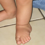 Someten a un niño a una cirugía pionera