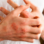 ¿Cómo evitar la dermatitis atópica?