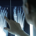 60% de los adultos padece deformidades en los dedos de los pies, advierten podólogos