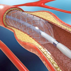 Colocan miles de stens coronarios en pacientes subsidiados