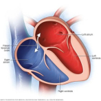 Infarto cerebral de origen incierto y Foramen Oval Permeable