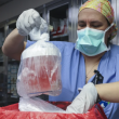 Fallece paciente que recibió primer trasplante de riñón de cerdo modificado genéticamente