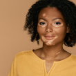 Día Mundial del Vitiligo: el estrés puede ser un desencadenante de la enfermedad