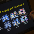 Los análisis de sangre para detectar el Alzheimer podrían estar a la vuelta de la esquina