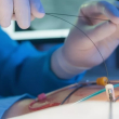 Proponen auditoría y evaluación de casos de angioplastia