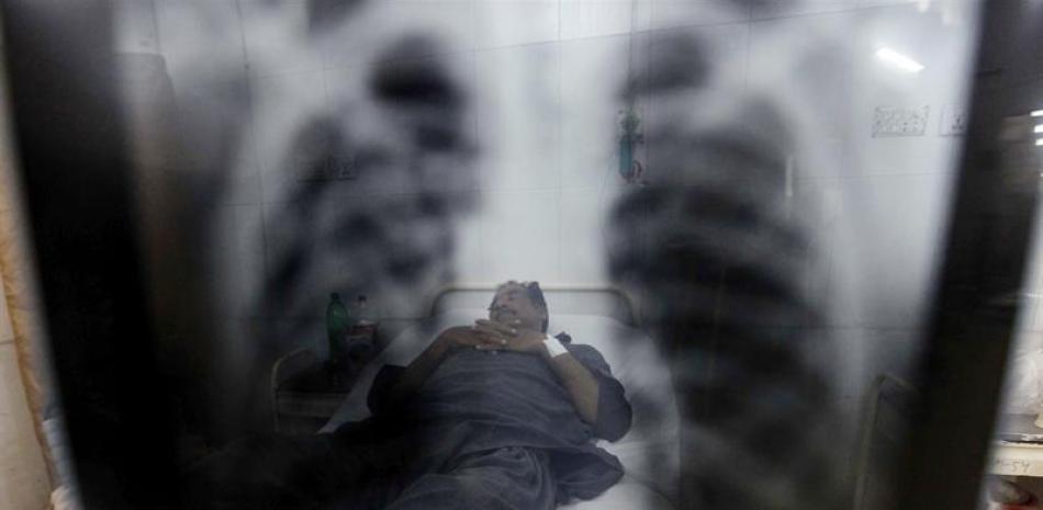Un paciente enfermo de tuberculosis recibe tratamiento médico en un hospital de Peshawar, Pakistán.