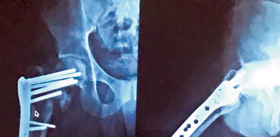 DEFICIENCIAS. Médicos ortopedas y traumatólogos han denunciado la baja calidad de las prótesis usadas en diversas cirugías.