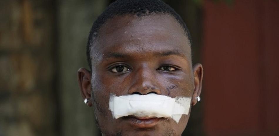 John Carey, de 21 años, quien resultó lesionado en las manifestaciones del viernes, posa para una foto en Puerto Príncipe, Haití, el 29 de septiembre de 2019. (AP Foto/Edris Fortune)