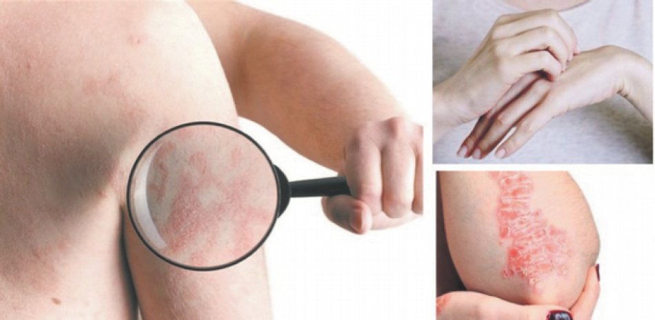 Especialistas aseguran que esta enfermedad también produce inflamación en ciertas zonas de la piel. /LISTÍN DIARIO