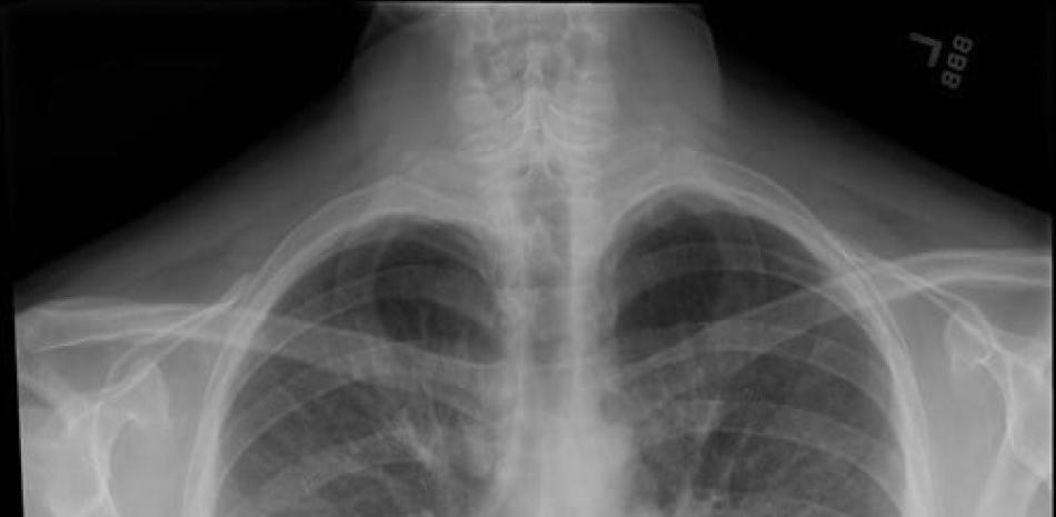 Radiografía de tórax de un paciente que está siendo tratado por una lesión pulmonar asociada a vapeo o cigarrillo electrónico. Europa Press