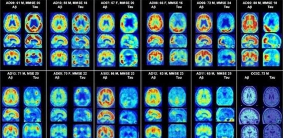 Investigadores identifican una prometedora herramienta diagnóstica del Alzheimer. Fuente: Europa Press