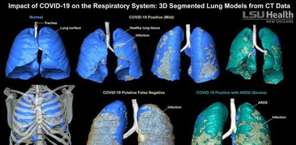 Los modelos 3D son un método sorprendentemente claro para evaluar visualmente la distribución de la infección relacionada con COVID-19 en el sistema respiratorio. - LSU HEALTH NEW ORLEANS