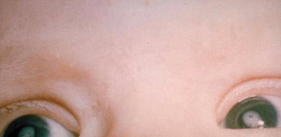 Bebé con cataratas por el síndrome de rubéola congénita.

Foto: EP/ CDC