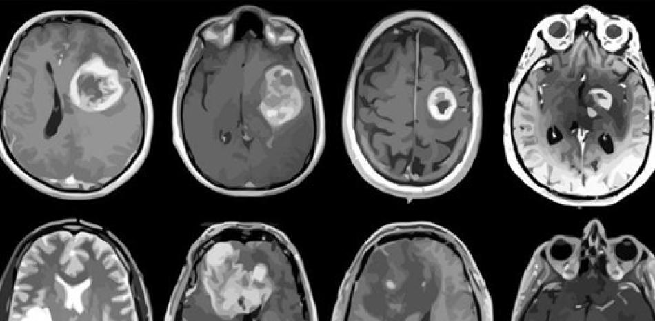 Glioblastoma, tumor cerebral agresivo mapeado en detalle genético y molecular.

Foto: ALBERT H. KIM/ EP