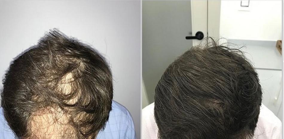 Paciente antes y después de someterse al procedimiento. Foto cortesía de la doctora