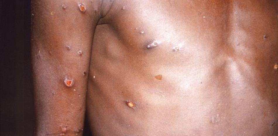 Esta imagen de 1997 proporcionada por los Centros para el Control y la Prevención de Enfermedades muestra el brazo derecho y el torso de una persona afectada con viruela símica.

Fot: CDC via AP