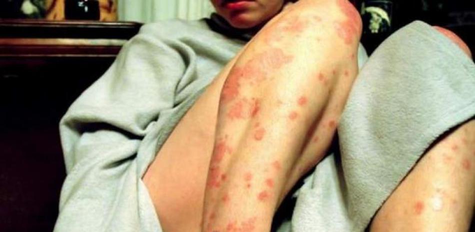 La dermatitis atópica causa enrojeciento y erupciones.