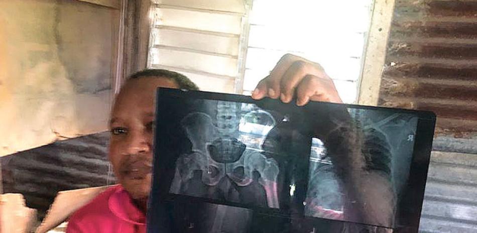 Manuel Gerarldo Santos Ventura muestra imágenes de rayos X de fracturas de su pierna izquierda. Foto Deyanira Polanco