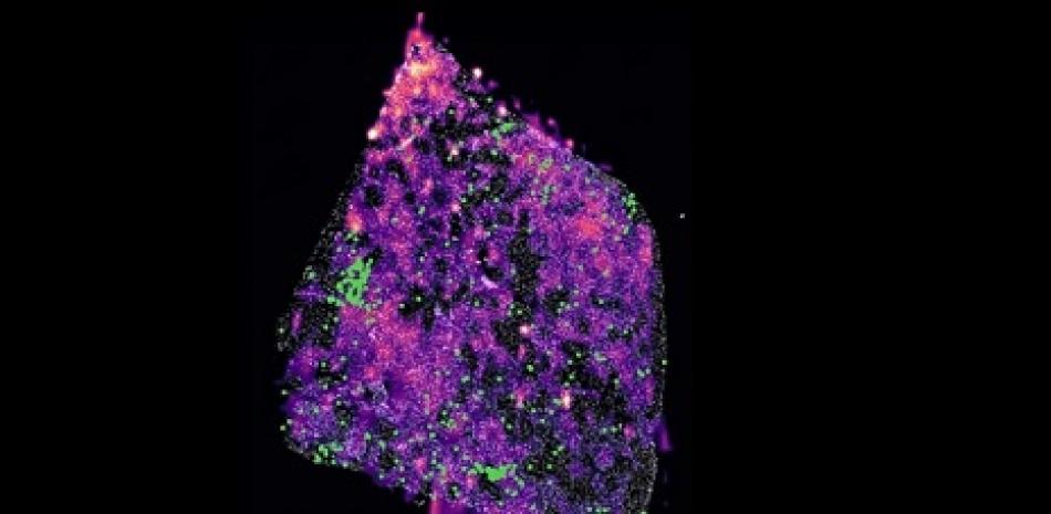 Tumor de glioma humano con una mutación que muestra grupos de células T en verde y cuyos puntos rosa representan concentraciones del metabolito D-2HG. Europa Press