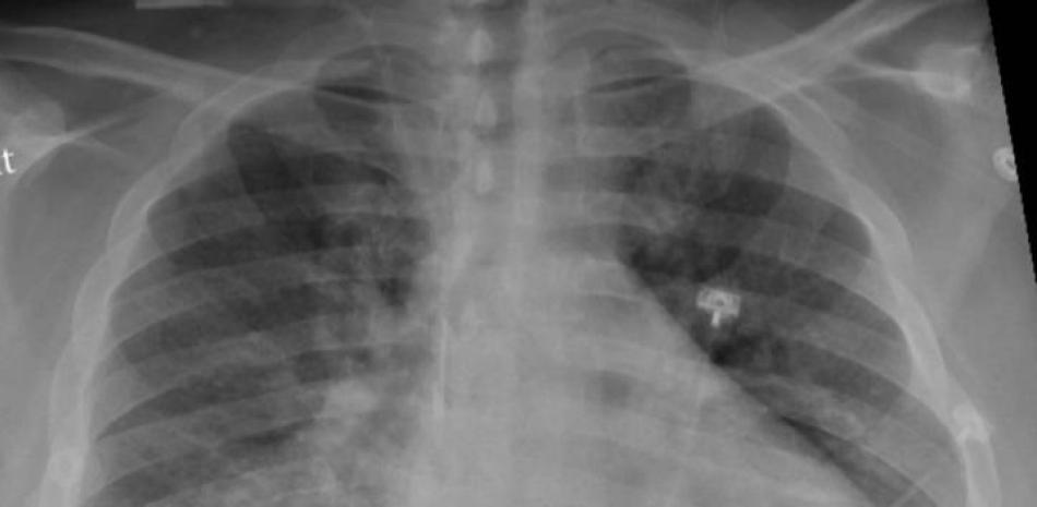 Archivo - La radiografía de tórax de un paciente positivo de COVID-19 que muestra una neumonía en la parte inferior de los pulmones. - RADIOLOGICAL SOCIETY OF NORTH AMERICA - Archivo